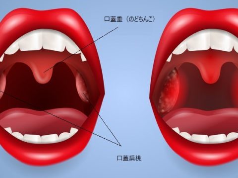 口蓋扁桃＆口蓋垂摘出術