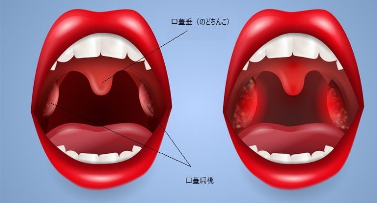 扁桃 腺 手術 体験 談