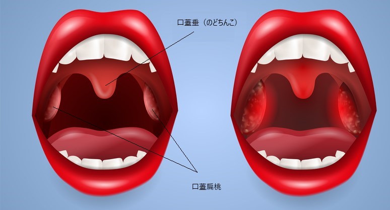 口蓋扁桃 口蓋垂摘出術 あるぷす薬局 あしたば薬局 浜松市 ベストシステムグループ